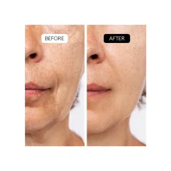 Best Aha Complex 10% Niacinamida|Aha/Bha