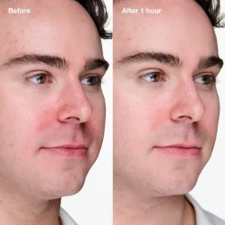 Online Anti-Blemish Solutions Clinical Advanced Clearing Gel Acido Salicilico|Imperfecciones