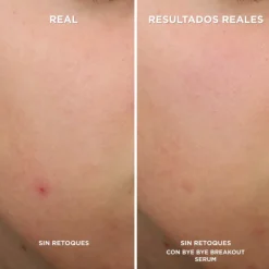 Hot BYE BYE BREAKOUT SERUM Acido Salicilico|Sensibilidad
