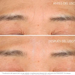 Online CAPTURE TOTAL HYALUSHOTCorrector de arrugas existentes y primeros signos de arrugas Acido Hialurónico|Arrugas