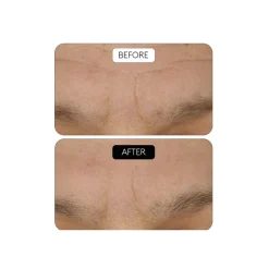 Outlet Clinical Beauty Filler Acido Hialurónico|Arrugas