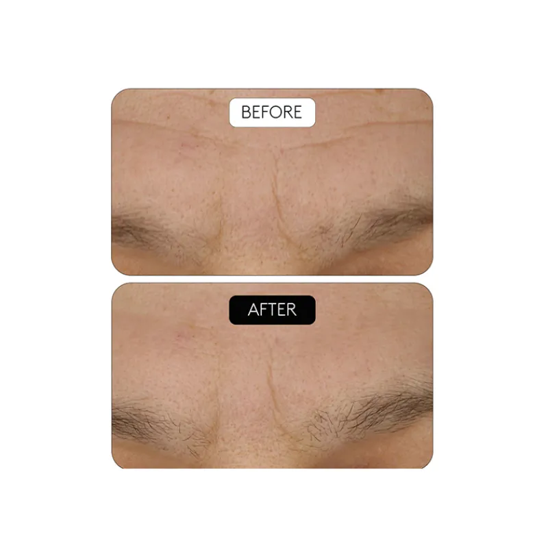 Outlet Clinical Beauty Filler Acido Hialurónico|Arrugas