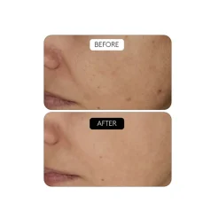 Outlet Clinical Beauty Filler Acido Hialurónico|Arrugas